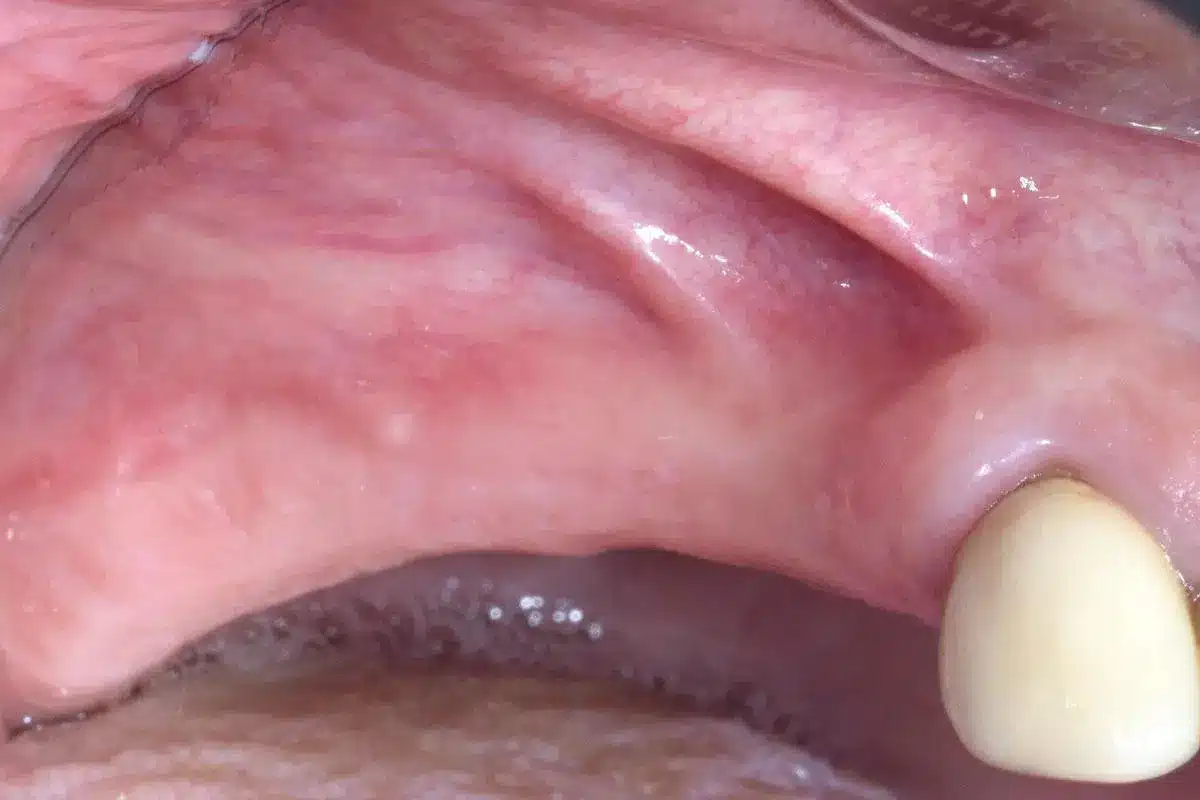 cerabone with jason membrane implant placement