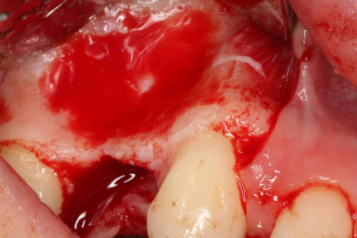 Initial situation of insufficient bone width
