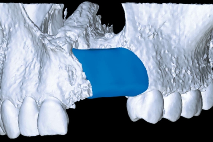 Reconstruction of a Unilateral Alveolar Cleft Using a Customized Allogenic Bone Block and Subsequent Dental Implant Placement in an Adult Patient