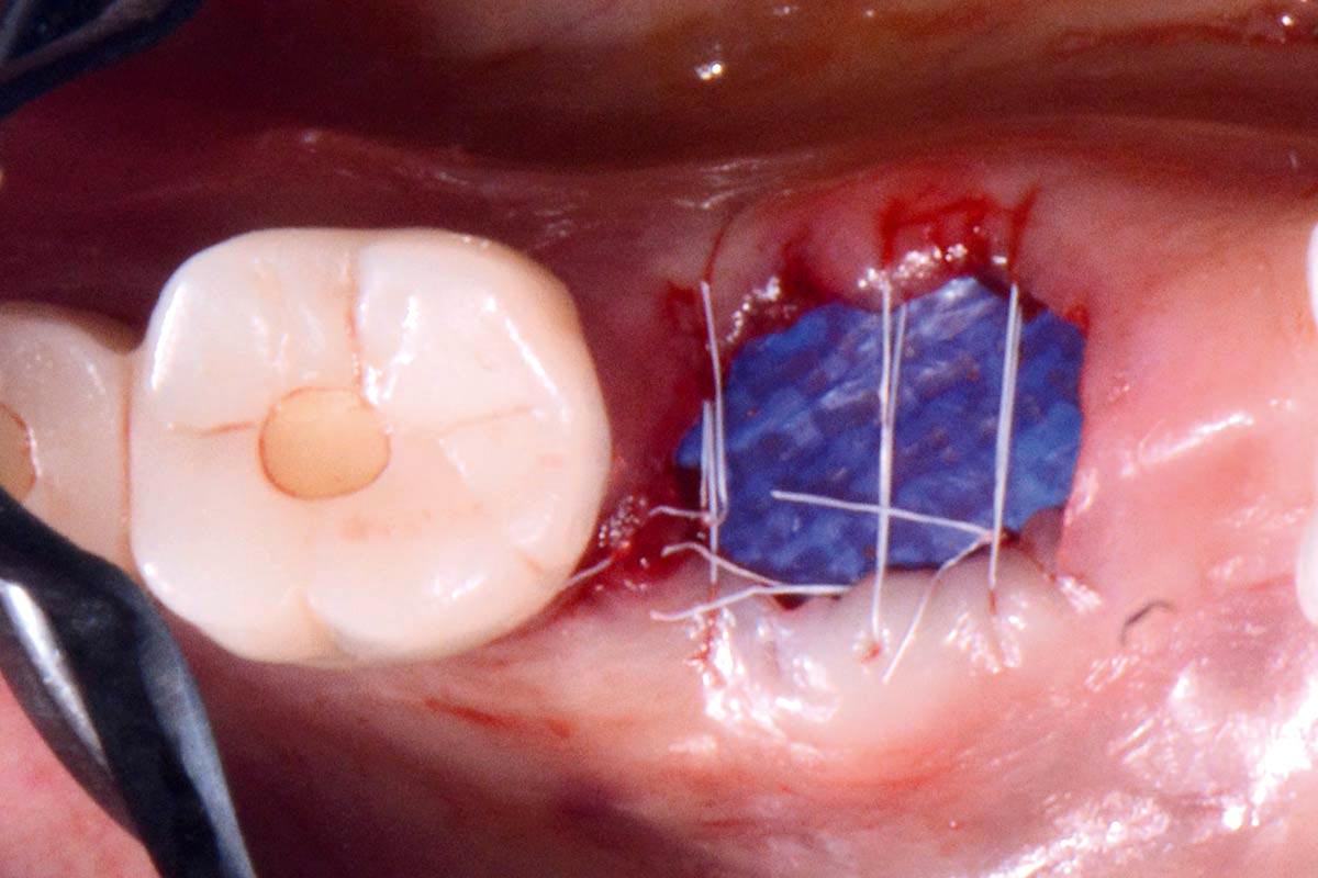 Socket Management - botiss biomaterials GmbH