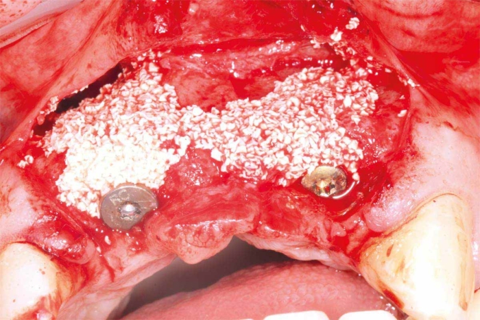 Replacement of a Failing Upper Anterior Bridge with Dental Implants