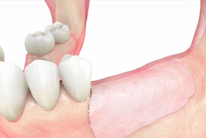 Shell technique with maxgraft® cortico
