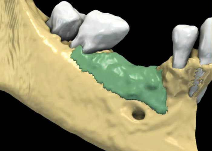 Efficacy of the NOVAMag® membrane for guided bone regeneration – radiographic evaluation of hard tissue gain
