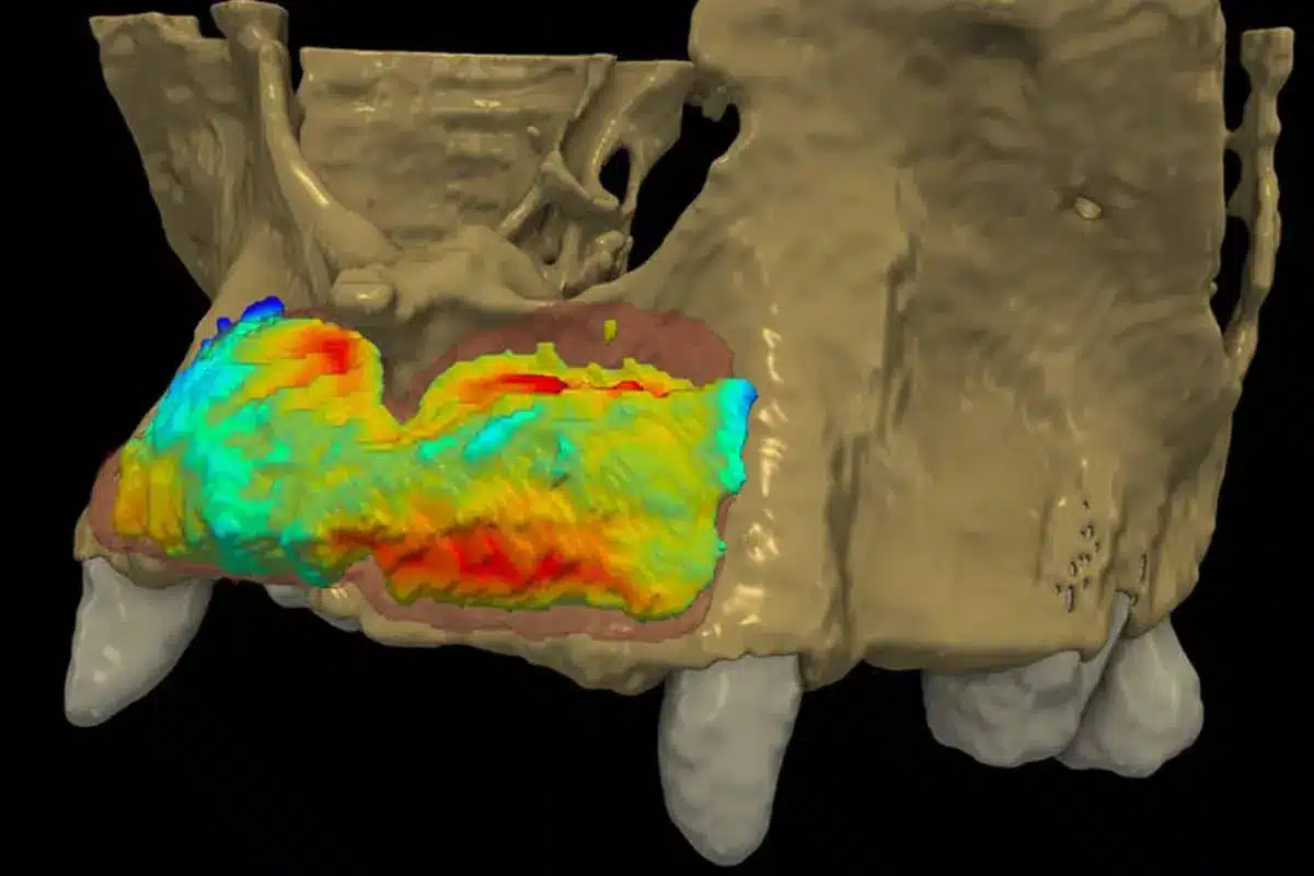 Efficacy and volume stability of maxgraft® bonebuilder