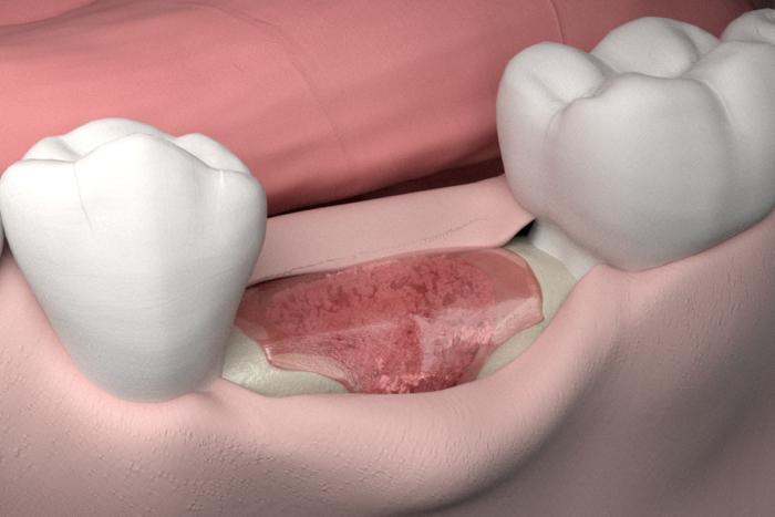 Ridge preservation with cerabone<sup>®</sup> and Jason<sup>®</sup> membrane