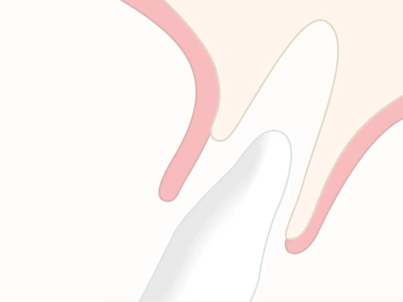 Illustration of a dental shield with pink and white elements representing gum and tooth structure.