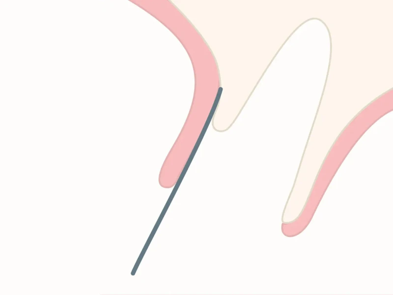 Illustration showing a tooth with surrounding gum tissue in a simplified design.