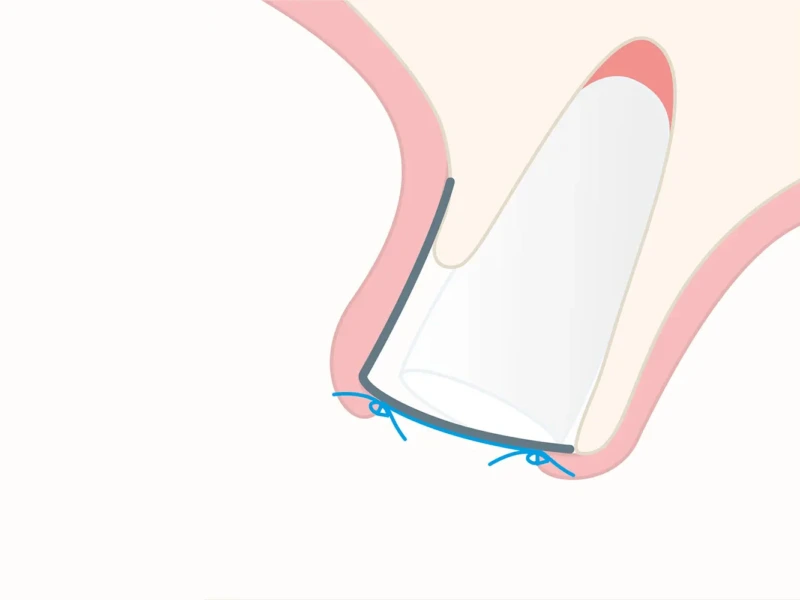 Illustration of a dental shield positioned within a gum line, showing its placement around a tooth.