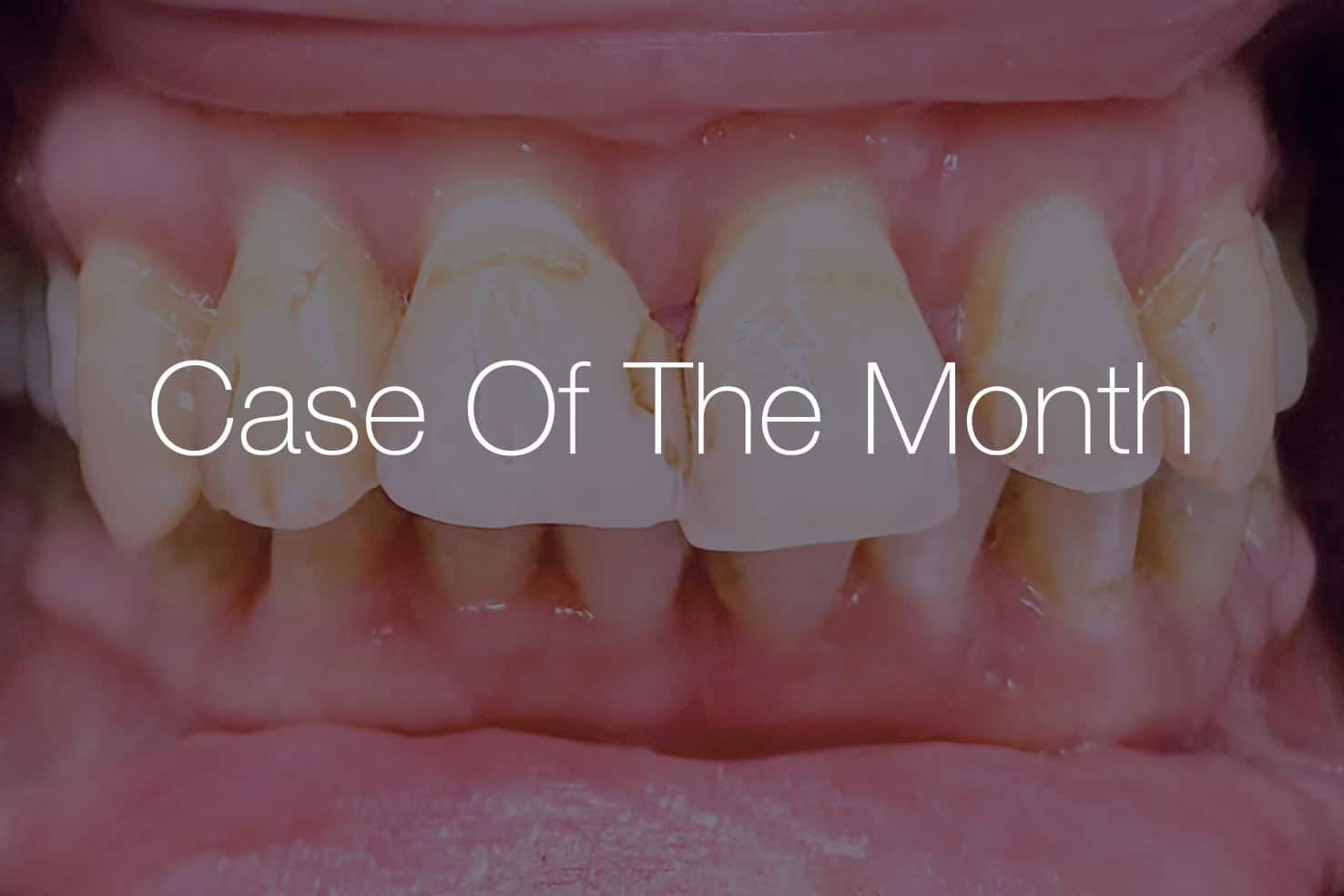 Close-up view of a set of teeth with a focus on dental health, featuring a mix of natural and artificial elements.