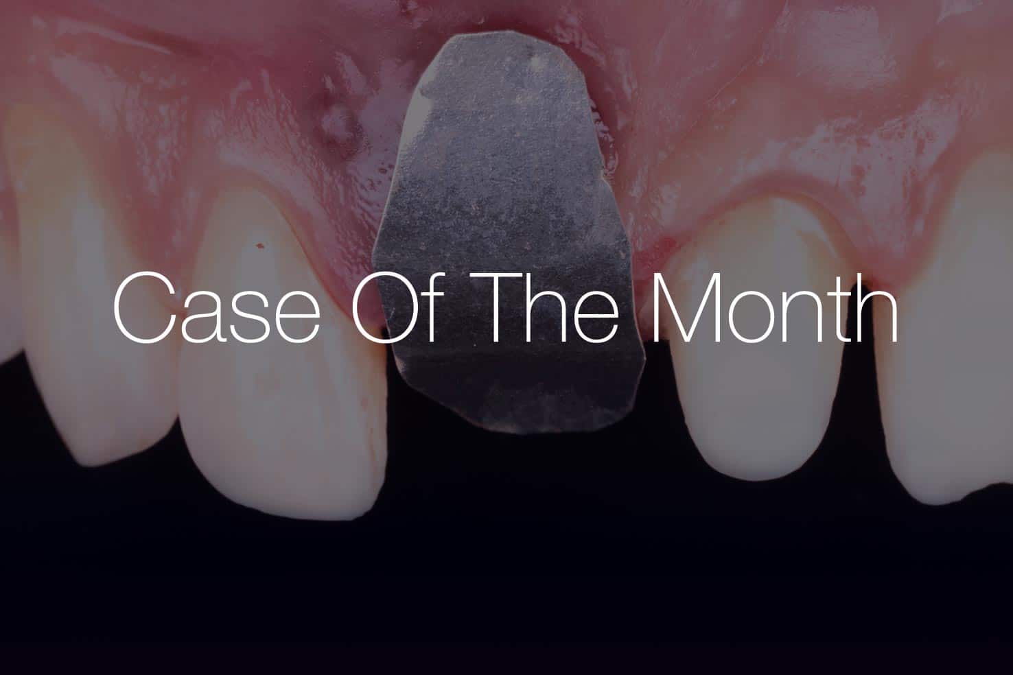Case Of The Month: close-up of a dental implant site showing pink gingiva, a metallic abutment between two front teeth, with a dark backdrop and high-contrast visuals.
