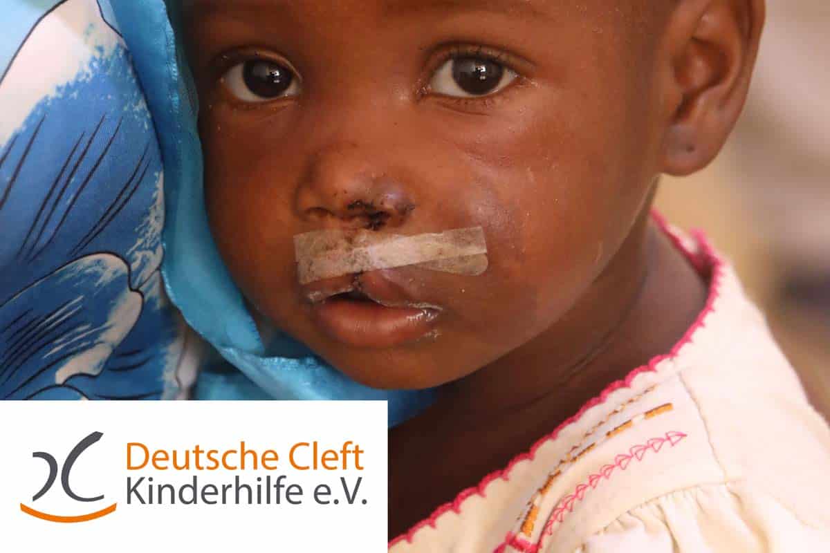 Close-up of a young child with a taped nose, dark brown skin, wearing a light garment, and the Deutsche Cleft Kinderhilfe e.V. logo visible in the lower left corner.