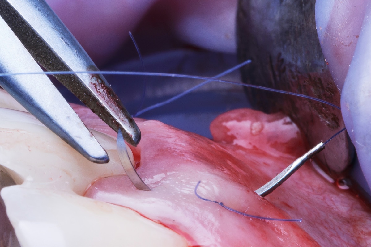 Close-up of dental surgery with precision instruments, tweezers and a curved needle weaving blue sutures through pink gum tissue in a sterile, clinical setting.