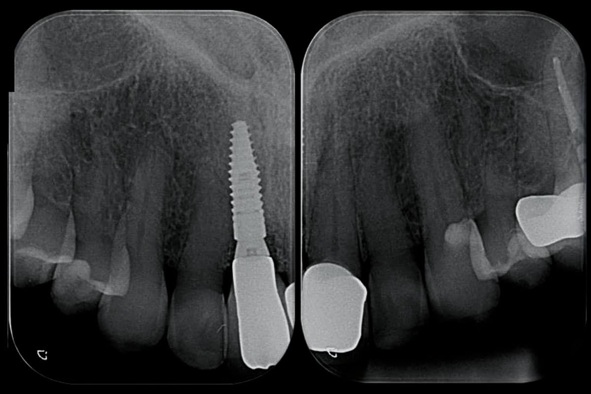 Periapical radiograph at one year follow-up post-implant placement.