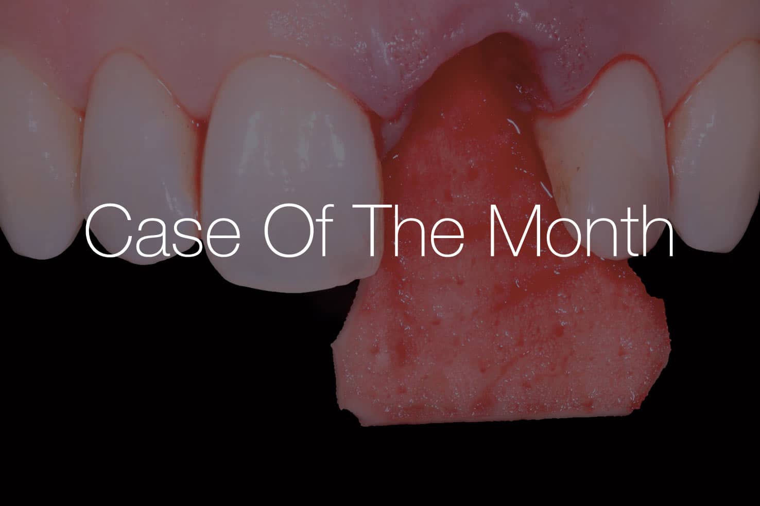Dr Alessandro Rossi campus Case of the Month: close-up of reddened gingival tissue between the front teeth with exposed pink mucosa and adjacent enamel.