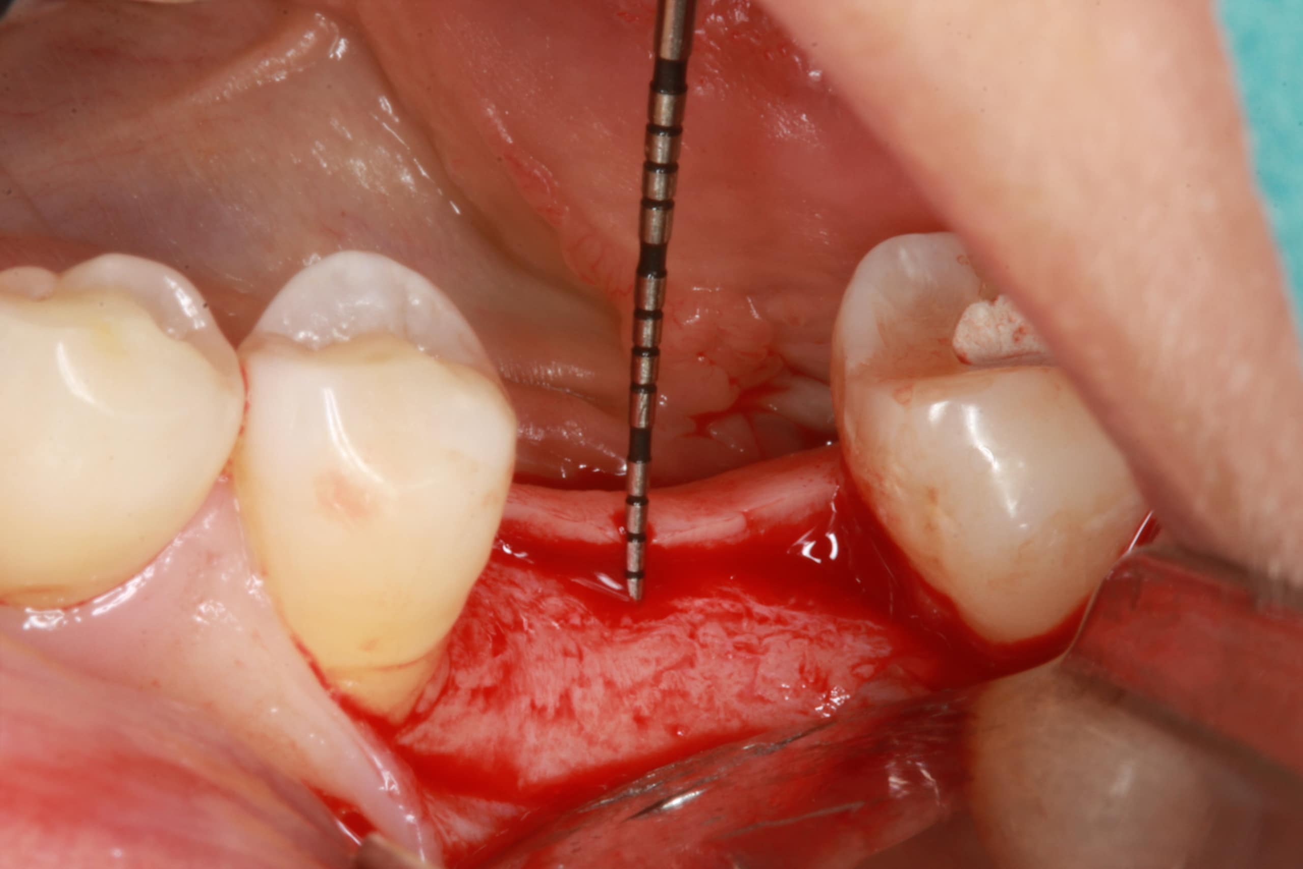 Puisys figure 3: lower jaw dental surgery showing a fine drill penetrating the alveolar crest beside molars, with exposed red gingival tissue and bone during implant placement.