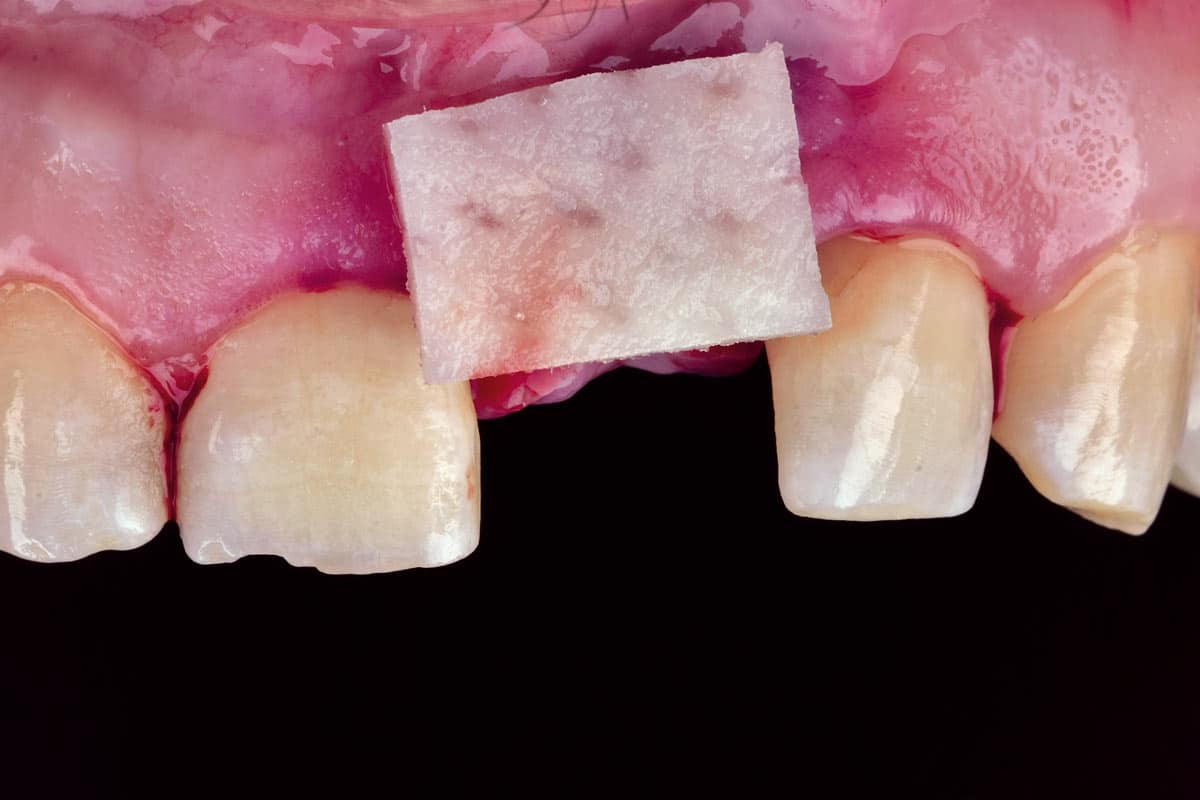 Placement of xenogeneic collagen matrix mucoderm® after hydration for 5-7 minutes.