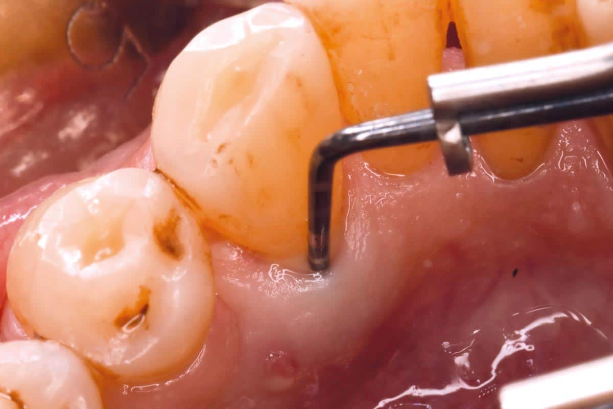 Initial situation: 13 mm pocket with suppuration on probing, infra-osseous defect