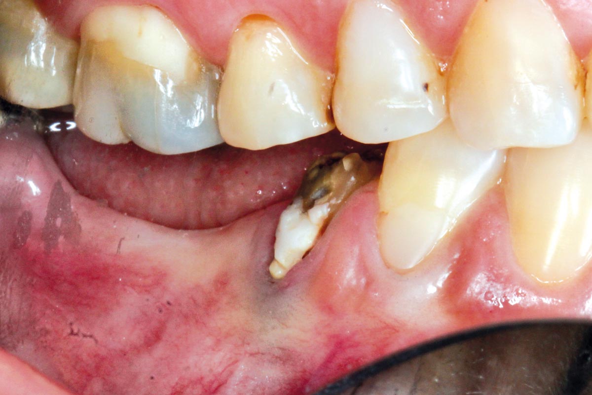 Initial clinical situation: Poor abutment health seen