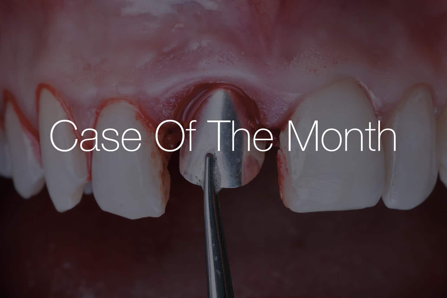 Close-up of a dental procedure with a metallic instrument near a central incisor and red gingival tissue; Case Of The Month overlay dominates the scene.