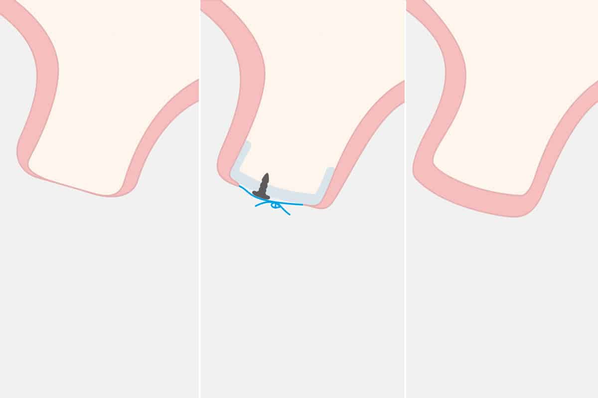 Tabanella study illustration of screw mucoderm dental implant procedure with pink gingiva, blue suturing line, and gray background