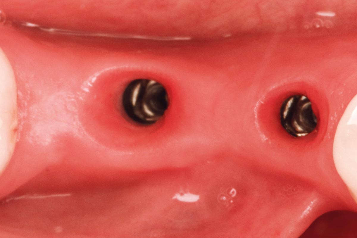 Implant placement: Emergence.