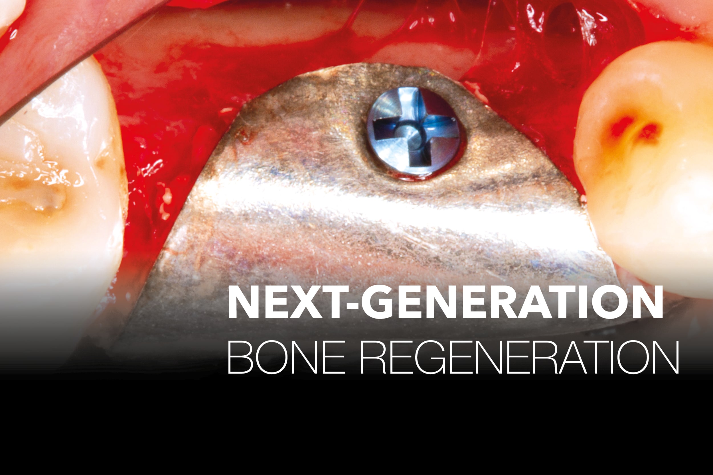 Next-Generation Bone Regeneration webinar with Dr. Zechner showing a metallic dental fixation in a red oral field, covering Mg-enhanced GBR.
