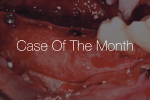 “Case Of The Month” shows the intraoral surgical site for horizontal ridge augmentation using the Sausage Technique with cerabone® +HyA and Jason® membrane.