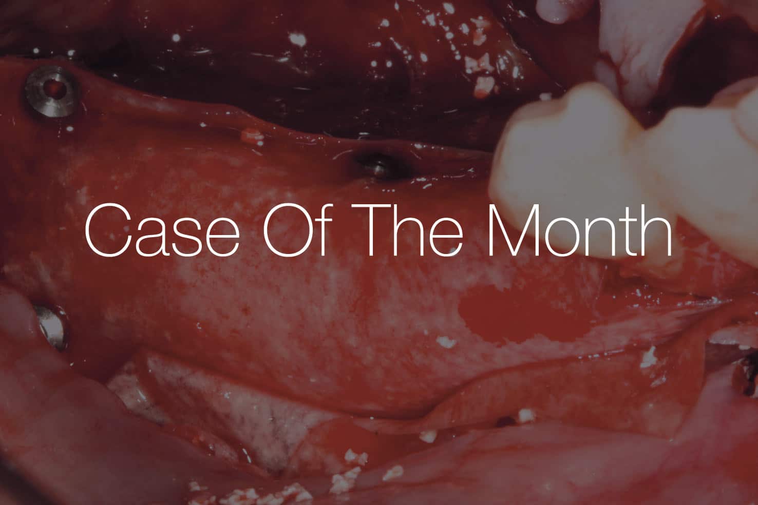 “Case Of The Month” shows the intraoral surgical site for horizontal ridge augmentation using the Sausage Technique with cerabone® +HyA and Jason® membrane.