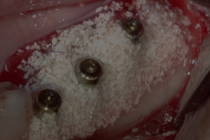 Gabi Chaushu and Liat Chaushu: posterior right maxilla during sinus elevation with simultaneous implant placement, red surgical field and two implant fixtures.