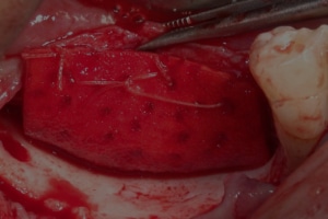 Vertical Bone Augmentation procedure showing a red surgical field as Prof. Gabi Chaushu reveals tissue over the prepared implant site.
