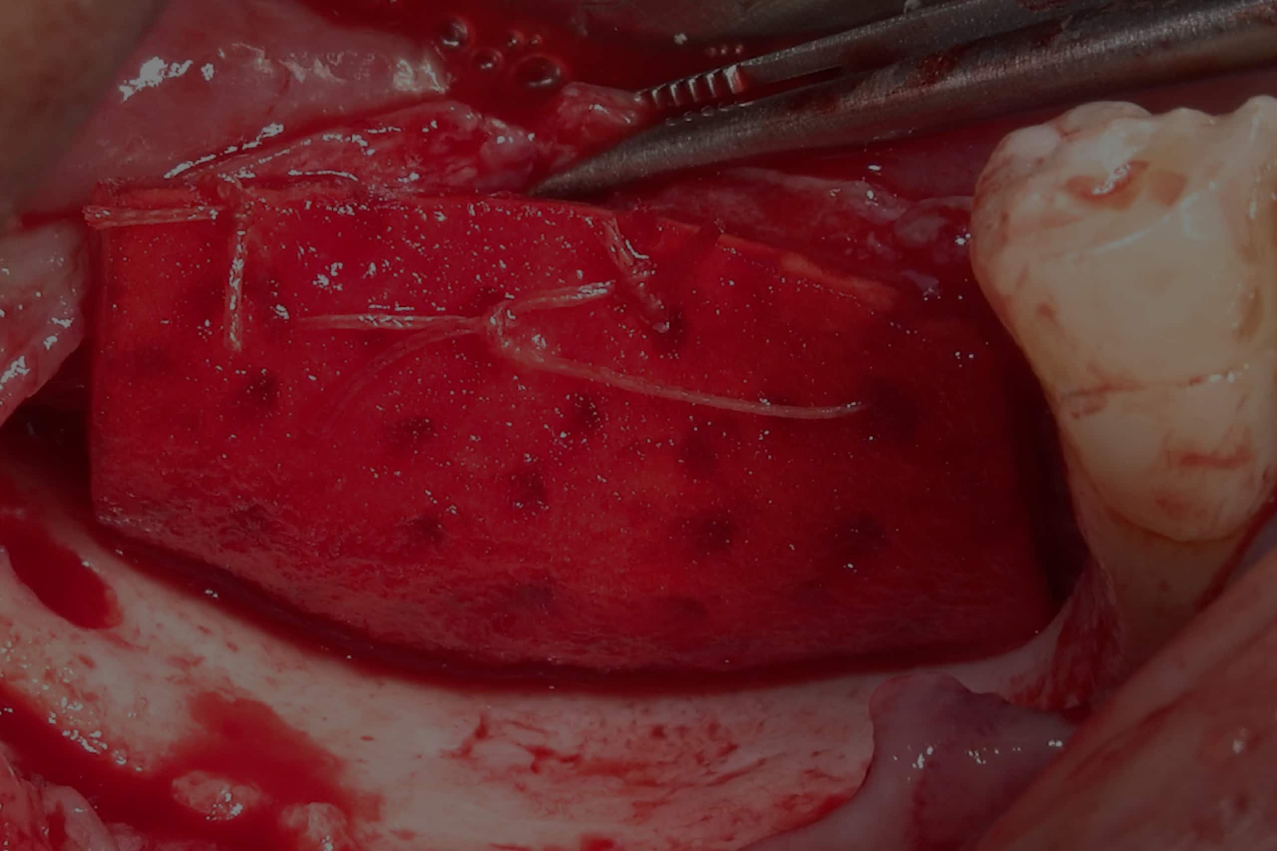 Vertical Bone Augmentation procedure showing a red surgical field as Prof. Gabi Chaushu reveals tissue over the prepared implant site.
