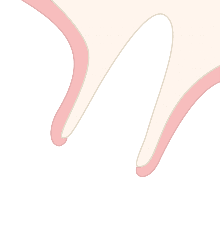 Diagram of Socket Type 1 with buccal bone intact after tooth extraction, showing preserved ridge walls and pink soft tissue outline around the socket.