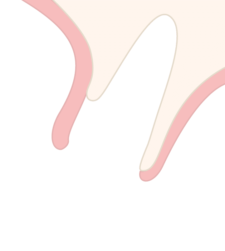 Illustration of compromised buccal bone without tooth, showing a thin pink buccal wall over a green socket contour for socket type 2.