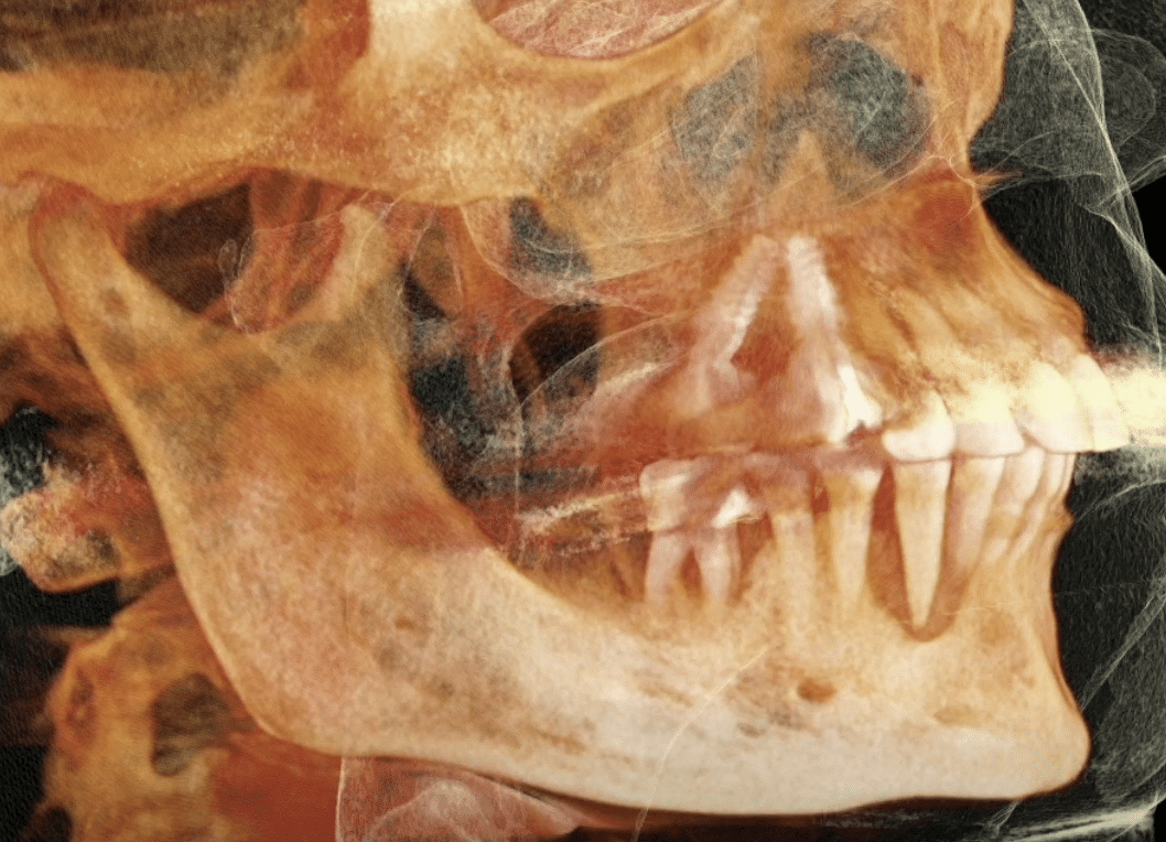 Gray radiographic view of the upper and lower jaw with visible tooth roots and skull contours, capturing fine anatomical detail for Tabanella.
