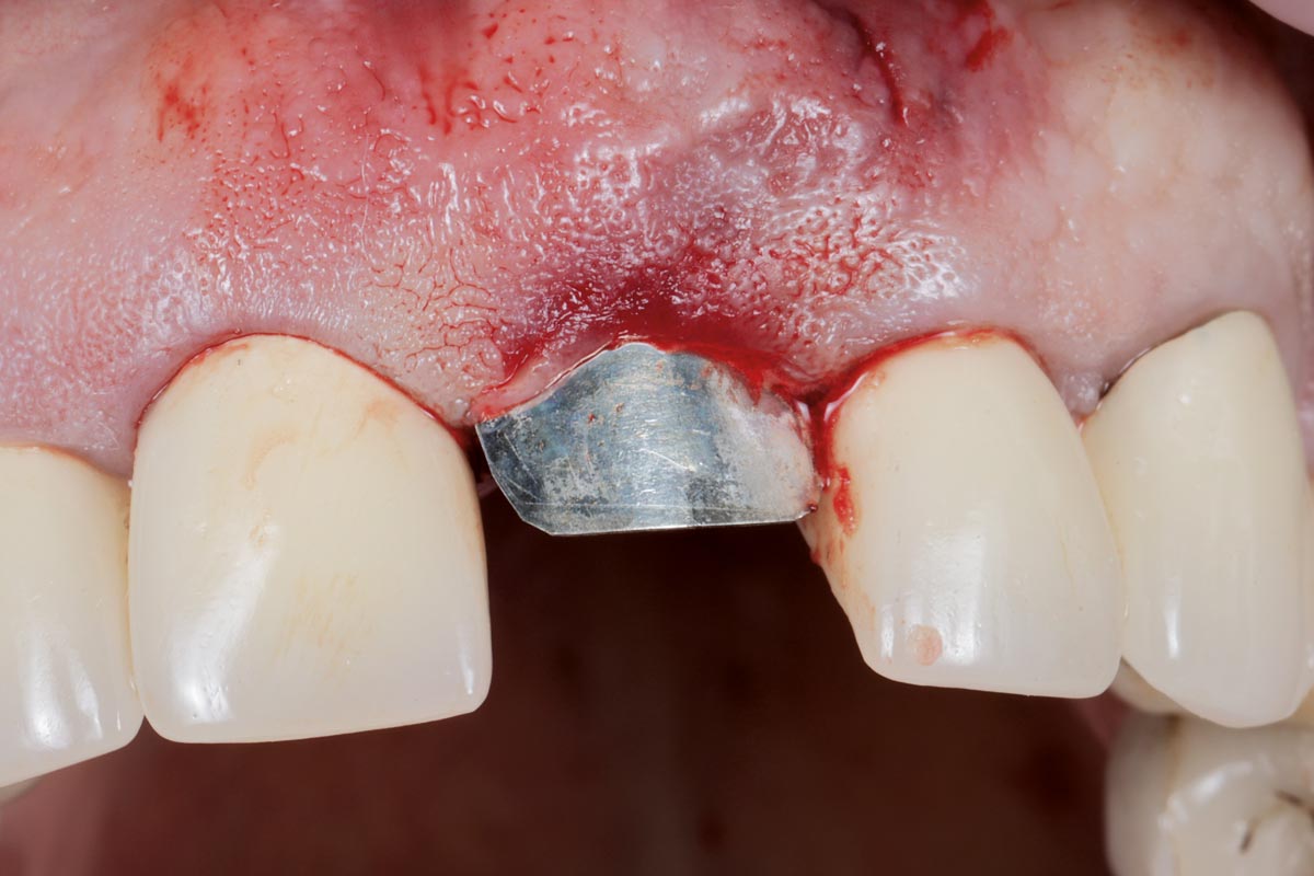 Application of the NOVAMag® SHIELD on the labial aspect