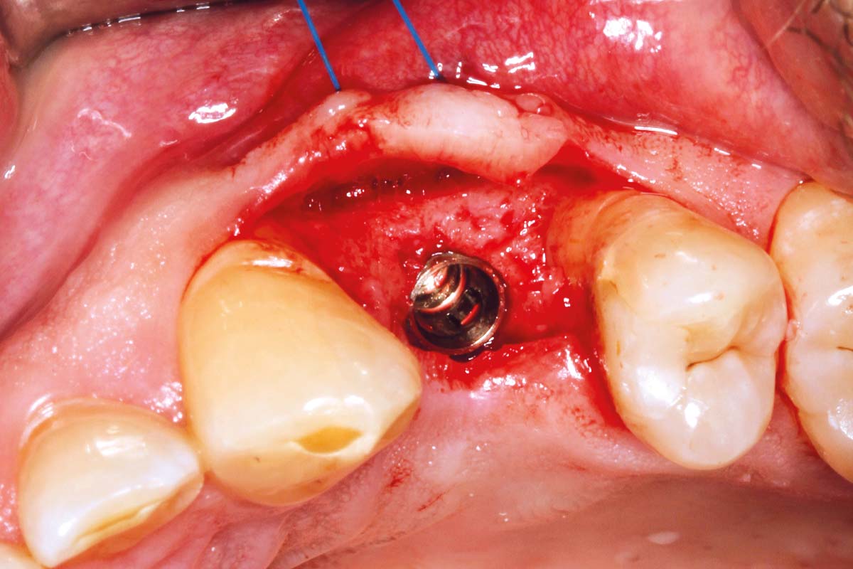 10-Implant-placement-performed-according-to-clinical-guidelines-without-additional-augmentation-procedures_Sigmar_Schnuttenhaus Implant placement performed according to clinical guidelines.