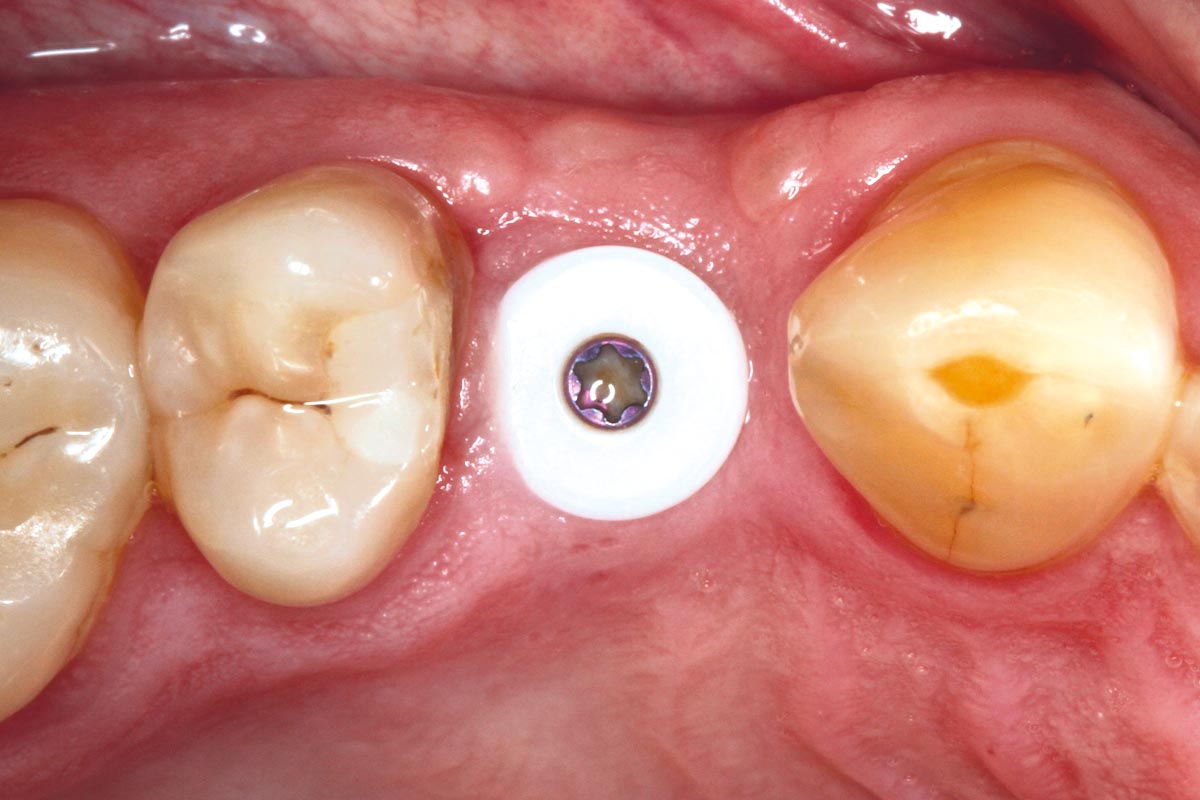 11-2-month-follow-following-implant-placement_Sigmar_Schnuttenhaus 2 month follow-up