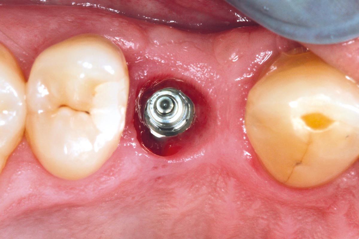 12-After-an-uncomplicated-2-month-healing-period-following-implant-placement,-optimal-conditions-for-prosthetic-restor_Sigmar_Schnuttenhaus After an uncomplicated 2-month healing period following implant placement, optimal conditions for prosthetic restoration