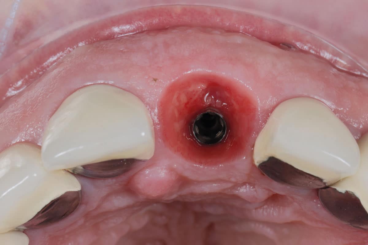 Implant site healing – 10 weeks follow-up