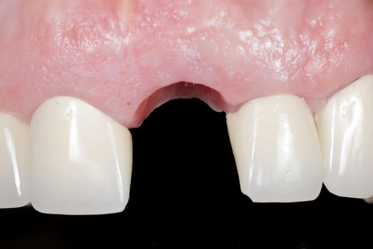 Implant site healing - frontal view