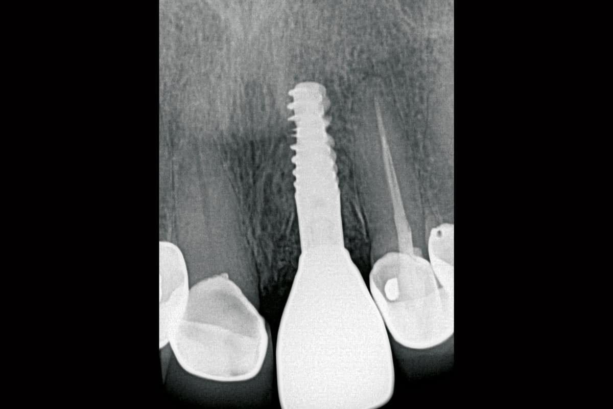 Final periapical radiograph