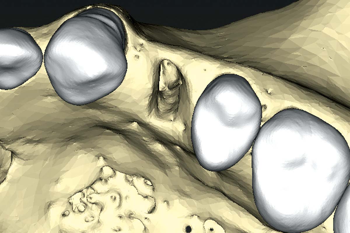 3-3D-pre-operative-CBCT_Sigmar_Schnuttenhaus Scan following tooth extraction