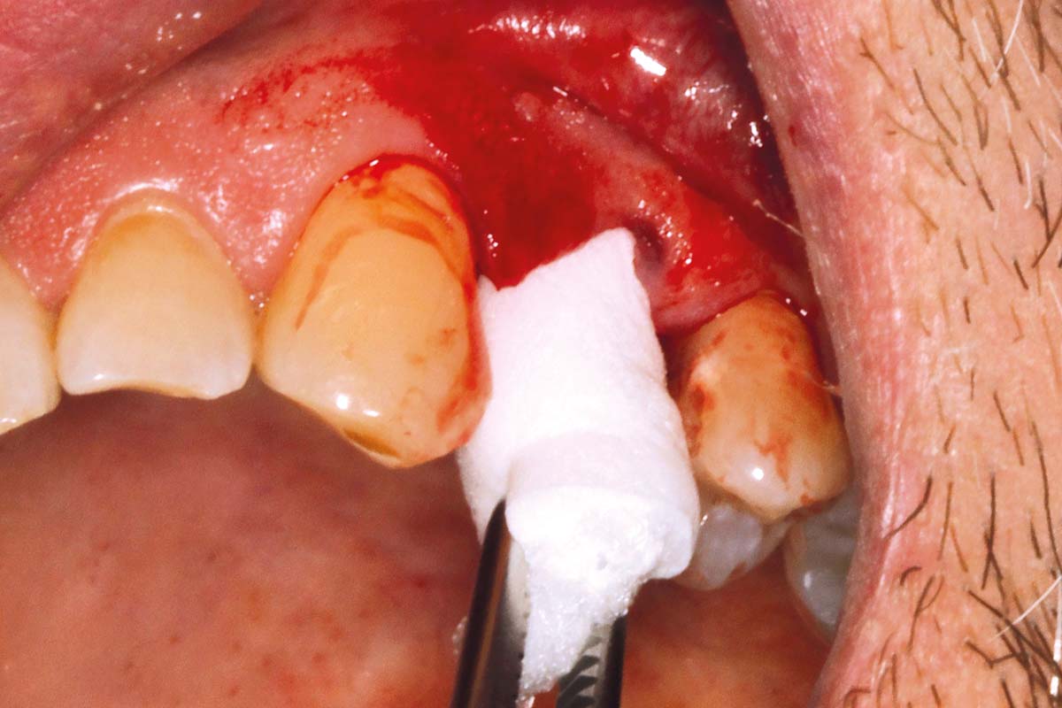 4-Placement-of-the-collacone-cone-following-atraumatic-extraction-and-curettage-of-the-socket_Sigmar_Schnuttenhaus Placement of the collacone® following atraumatic extraction and curettage of the socket