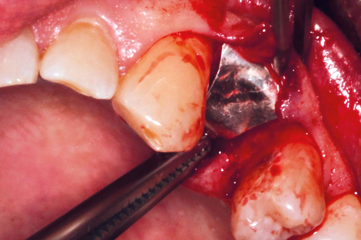 6-Placement-of-the-trimmed-magnesium-membrane-following-preparation-of-a-subperiosteal-buccal-pouch_Sigmar_Schnuttenhaus Placement of the trimmed NOVAMag® SHIELD following preparation of a subperiosteal buccal pouch