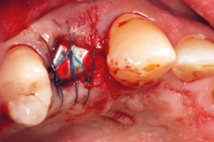 Stabilization suture for NOVAMag® SHIELD fixation. Open healing of NOVAMag® SHIELD was performed