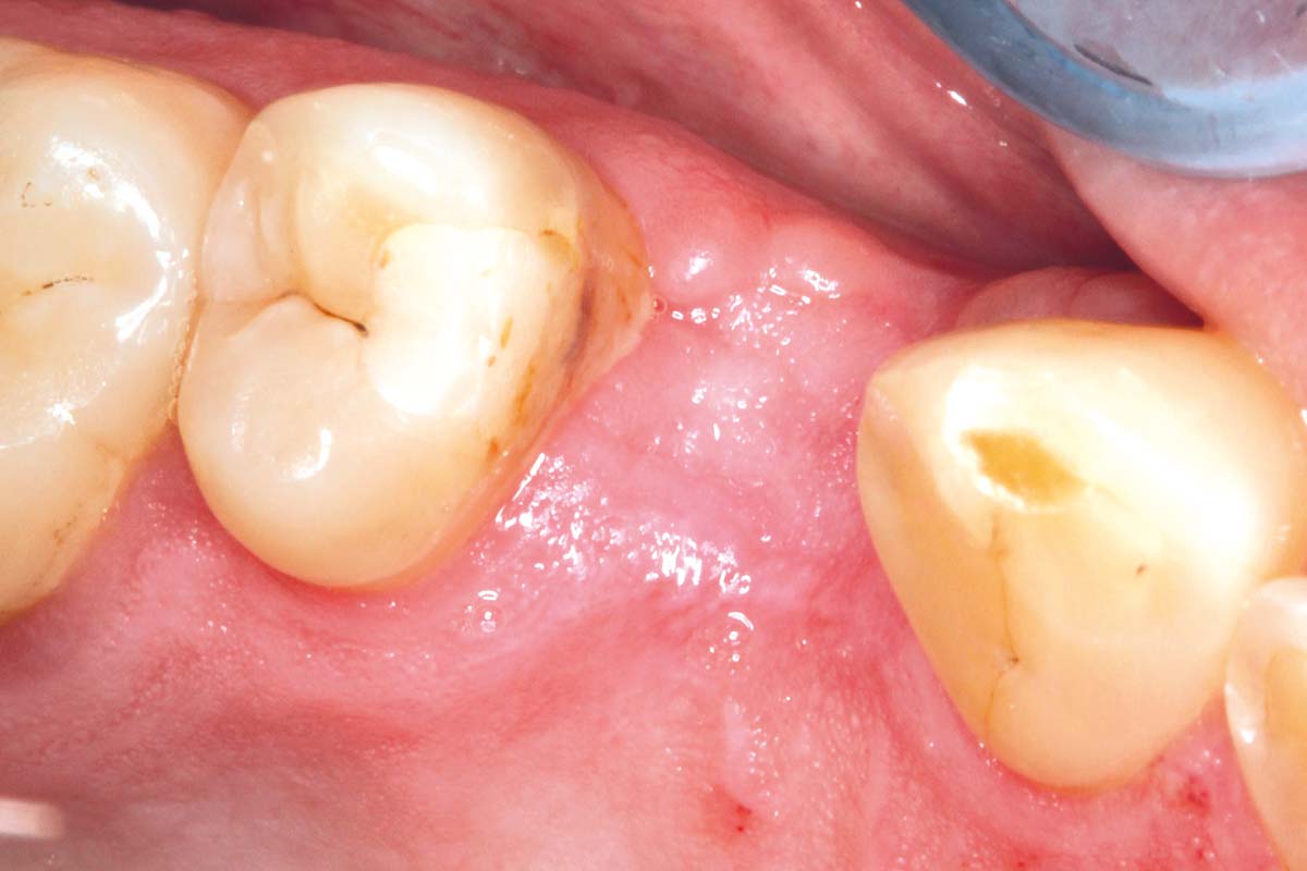 8-Clinical-follow-up-after-3-months-demonstrating-optimal-healing-of-the-extraction-site_Sigmar_Schnuttenhaus Clinical follow-up after 3 months demonstrating optimal healing of the extraction site