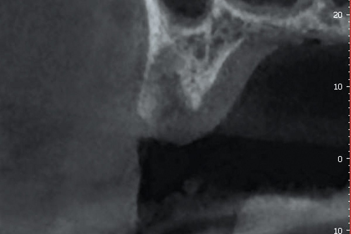 9-CBCT-showing-well-preserved-bone-contour-including-the-buccal-lamella_Sigmar_Schnuttenhaus CBCT showing well-preserved bone contour including the buccal lamella