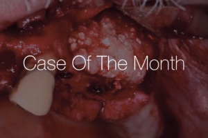 Sutured, exposed posterior maxilla during sinus augmentation and lateral ridge reconstruction with stable 3-year results, “Case Of The Month”.
