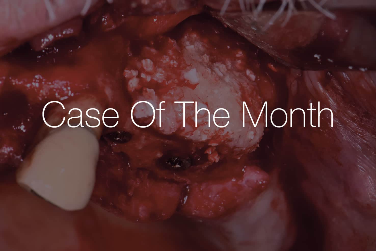 Sutured, exposed posterior maxilla during sinus augmentation and lateral ridge reconstruction with stable 3-year results, “Case Of The Month”.