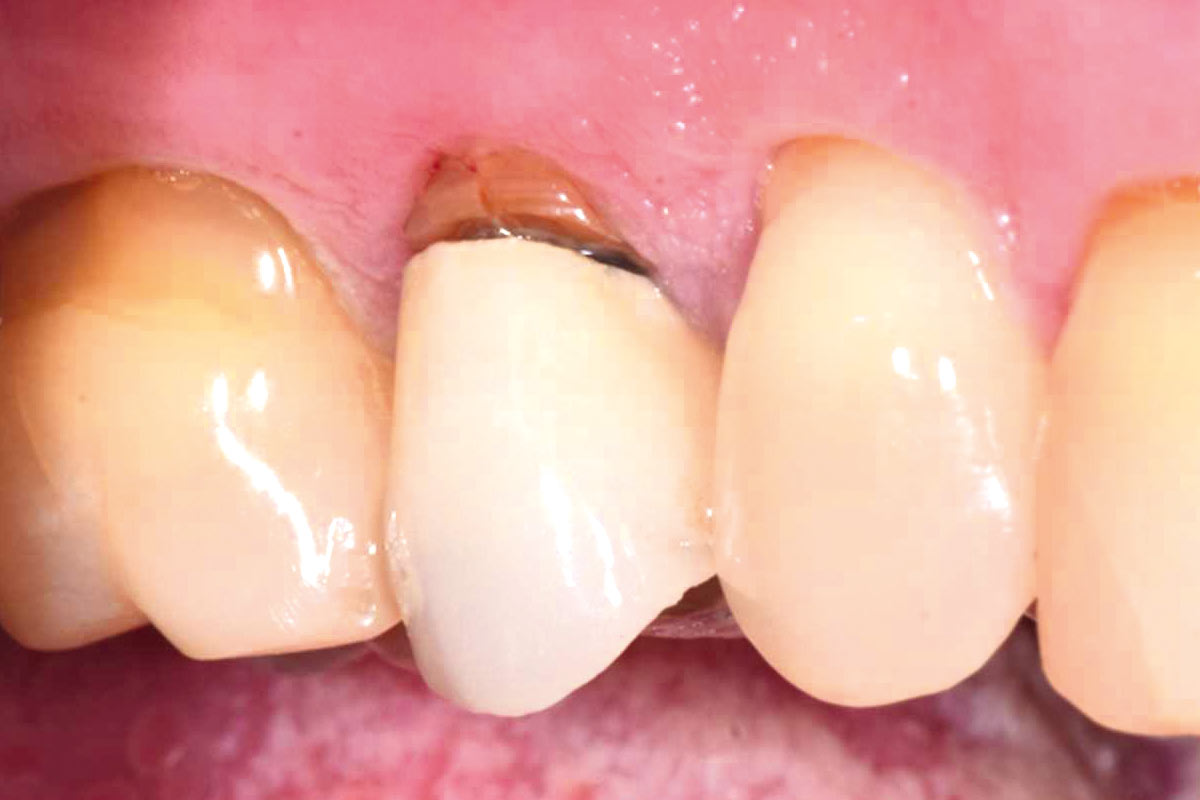 1--Initial-Clinical-Situation_Dr_Robert_Kemper Initial clinical situation: vertically fractured root